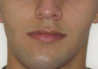 Imagem inicial com assimetria de face - Clínica Cliniface