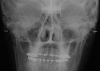 Telerradiografia frontal inicial - Clínica Cliniface