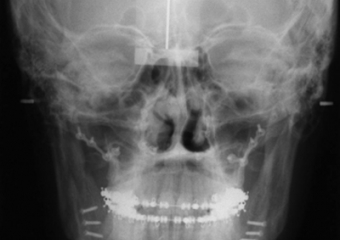 Telerradiografia frontal após cirurgia - Clínica Cliniface