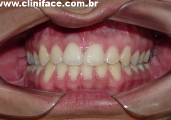 Mordida após remoção do aparelho - Clínica Cliniface