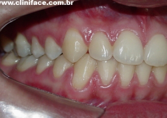 Mordida após remoção do aparelho - Clínica Cliniface