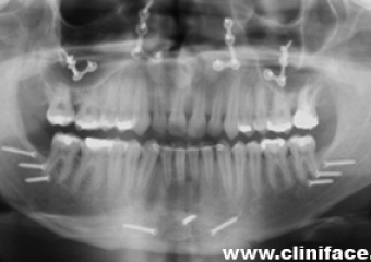  Rx final - Clínica Cliniface