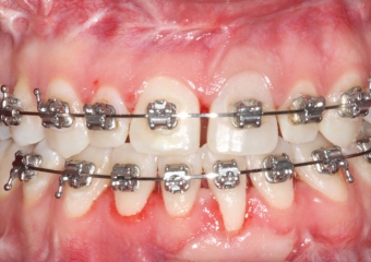 Mordida após a cirurgia - Clínica Cliniface
