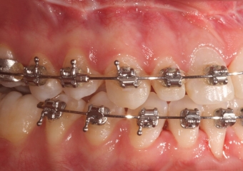 Mordida inicial - Clínica Cliniface