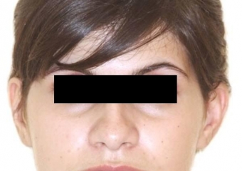  Imagem após a cirurgia - Clínica Cliniface