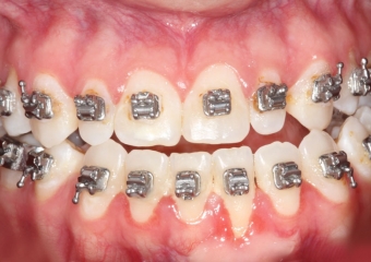 Mordida inicial - Clínica Cliniface