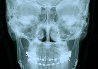  Telerradiografia frontal após a cirurgia - Clínica Cliniface