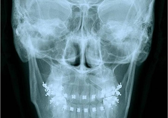 Telerradiografia frontal inicial - Clínica Cliniface