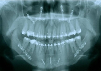  Rx após a cirurgia - Clínica Cliniface