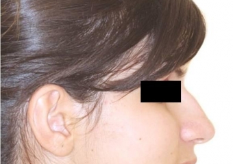  Imagem perfil após a cirurgia - Clínica Cliniface