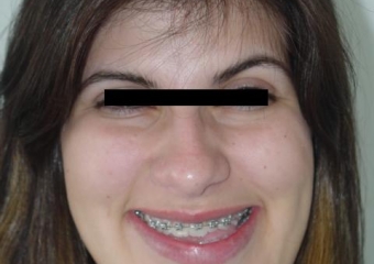 Sorriso inicial - Clínica Cliniface