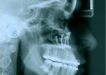 Telerradiografia após a cirurgia - Clínica Cliniface