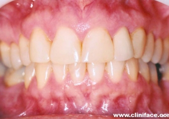 Imagem inicial e final de caso de agenesia dental, reabilitado com implante unitário no elemento 12 - Clínica Cliniface
