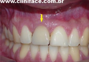 Prótese fixa de porcelana sobre o implante - Clínica Cliniface