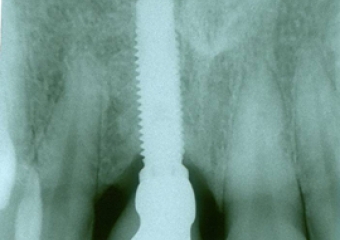 Raio X com prótese de porcelana sobre o implante - Clínica Cliniface