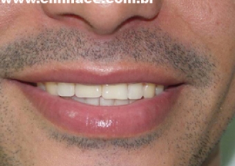 Imagem do caso terminado em fevereiro de 2008 - Clínica Cliniface