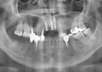 Rx após instalação dos implantes - Clínica Cliniface