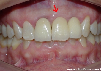 Protese fixa em porcelana no elemento 21 - Clínica Cliniface