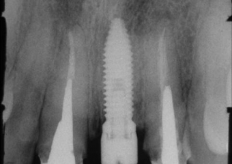 Rx com o implante já instalado  - Clínica Cliniface
