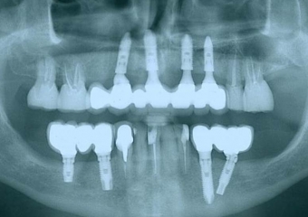 Rx com prótese fixa em porcelana, sobre implantes superiores Cone Morse - Clínica Cliniface