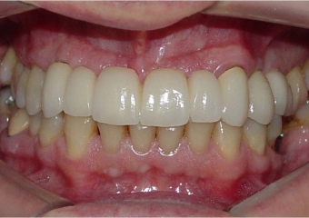 Próteses fixas em porcelana sobre implantes - Clínica Cliniface