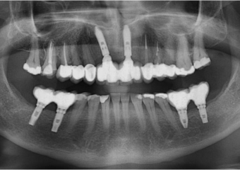 Raio X das próteses fixas em porcelana - Clínica Cliniface