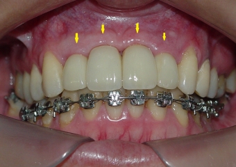  Dentes individuais sobre implantes, em porcelana pura - Clínica Cliniface