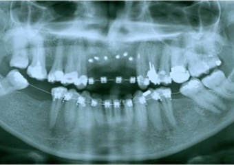 Rx do enxerto ósseo - Clínica Cliniface