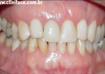 Imagem atual (2009) das Próteses Sobre os Elementos 12 e 22, instalados em 1998 - Clínica Cliniface