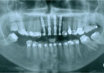 Raio X das próteses provisórias sobre implantes Cone Morse - Clínica Cliniface