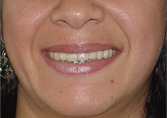  Sorriso com dentes individuais em porcelana pura - Clínica Cliniface