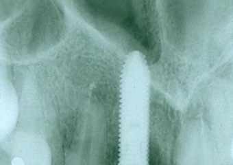 Rx dos implantes Cone Morse instalados  - Clínica Cliniface
