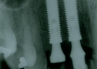Rx após extração e implantes imediatos nos dentes 12 e 22   - Clínica Cliniface
