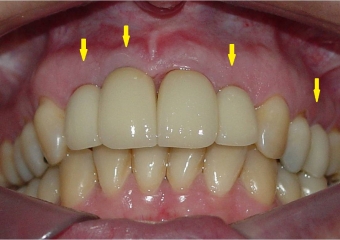  Dentes individuais em porcelana  - Clínica Cliniface