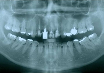 Raio X inicial  - Clínica Cliniface