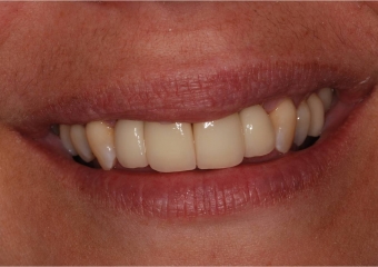   Sorriso final, do caso terminado em abril de 2013  - Clínica Cliniface