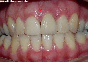 Prótese fixa em porcelana instalada - Clínica Cliniface