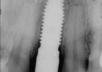 Raio X do implante instalado - Clínica Cliniface