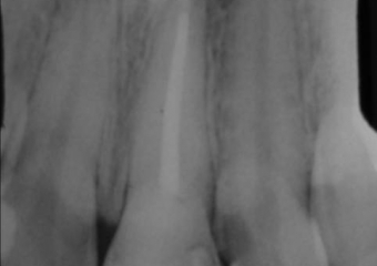 Raio X inicial do dente 21 fraturado - Clínica Cliniface