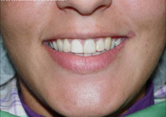 Sorriso inicial - Clínica Cliniface