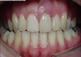 Dente 21 com fratura - Clínica Cliniface