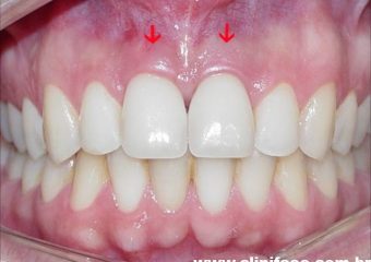 Próteses finais em porcelana - Clínica Cliniface