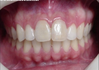 Reimplante dos dentes 11 e 21, após avulsão - Clínica Cliniface