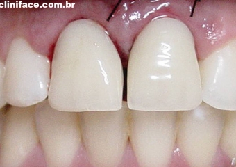 Próteses provisórias imediatas nos elementos 11 e 21 - Clínica Cliniface