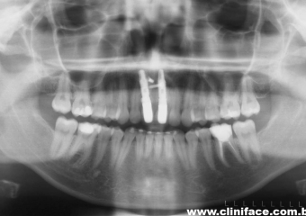 Rx após extração e implantes imediatos - Clínica Cliniface