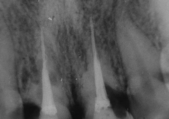 Reabsorção do 11 e 21, após 6 anos do reimplante - Clínica Cliniface