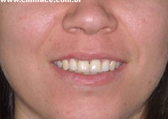 Sorriso final do caso terminado em julho de 2005 - Clínica Cliniface