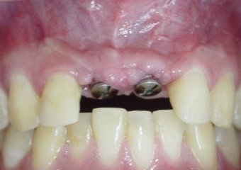 Dois implantes instalados, com cicatrizadores - Clínica Cliniface