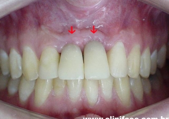 Dentes provisórios instalados - Clínica Cliniface