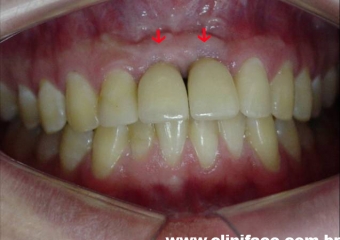 Próteses em porcelana instaladas - Clínica Cliniface